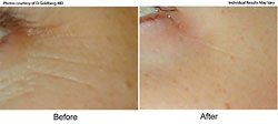 Before and After Progression - Laser Genesis Medical Spa Treatments in Santa Barbara