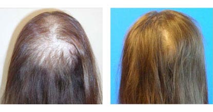 Laser Hair Restoration in Santa Barbara - Female Before and After