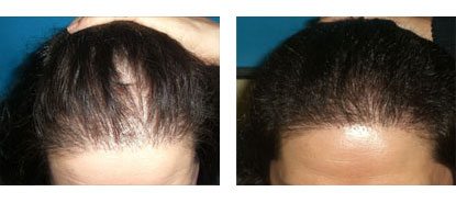 Laser Hair Restoration in Santa Barbara - Female Before and After