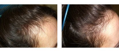 Laser Hair Restoration in Santa Barbara - Female Before and After