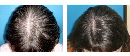 Laser Hair Restoration in Santa Barbara - female Before and After