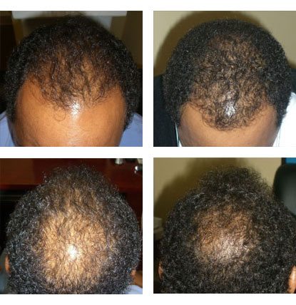 Laser Hair Restoration Services at Evolutions Medical and Day Spa