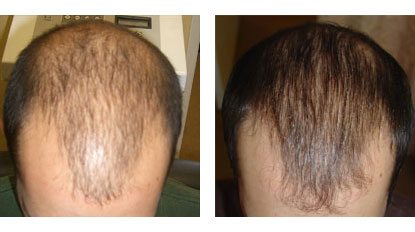 Laser Hair Restoration in Santa Barbara - Male Before and After