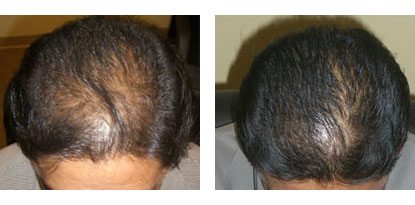 Laser Hair Restoration in Santa Barbara - Male Before and After