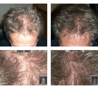 Before And After- Laser Hair Restoration Services at Evolutions Medical Spa