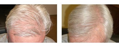 Before And After: Laser Hair Restoration