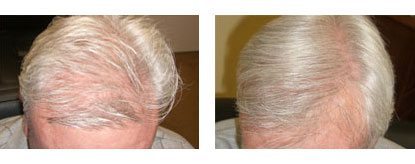 Laser Hair Restoration in Santa Barbara - Male Before and After