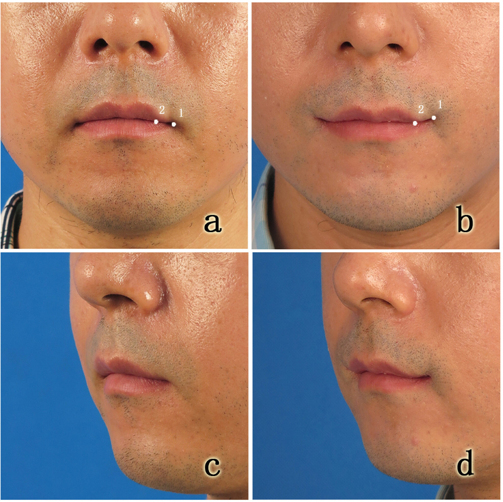 Corner Mouth Lift - Minimally Invasive Procedures in Santa Barbara