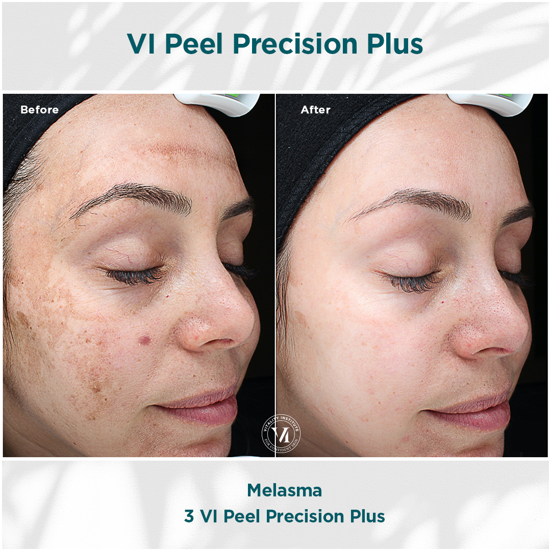Melasma - VI Peel Treatments at Evolutions Medical & Day Spa in Santa Barbara