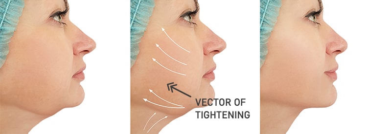 Submental and/or lower face liposuction is another way to contour the area under the chin. 