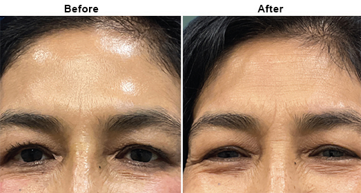 Botox: Before And After
