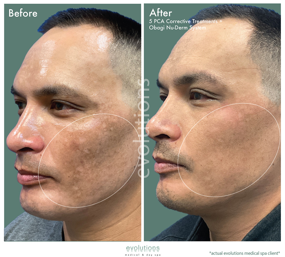 Pca Corrective Obagi Nuderm O Tacbas