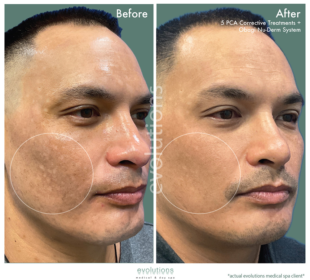 Pca Corrective Obagi Nuderm O Tacbas