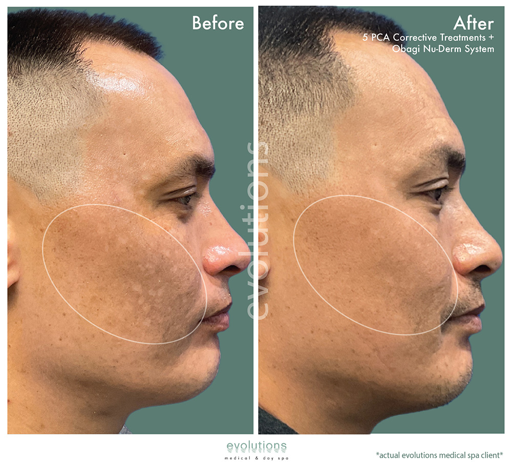 Pca Corrective Obagi Nuderm O Tacbas