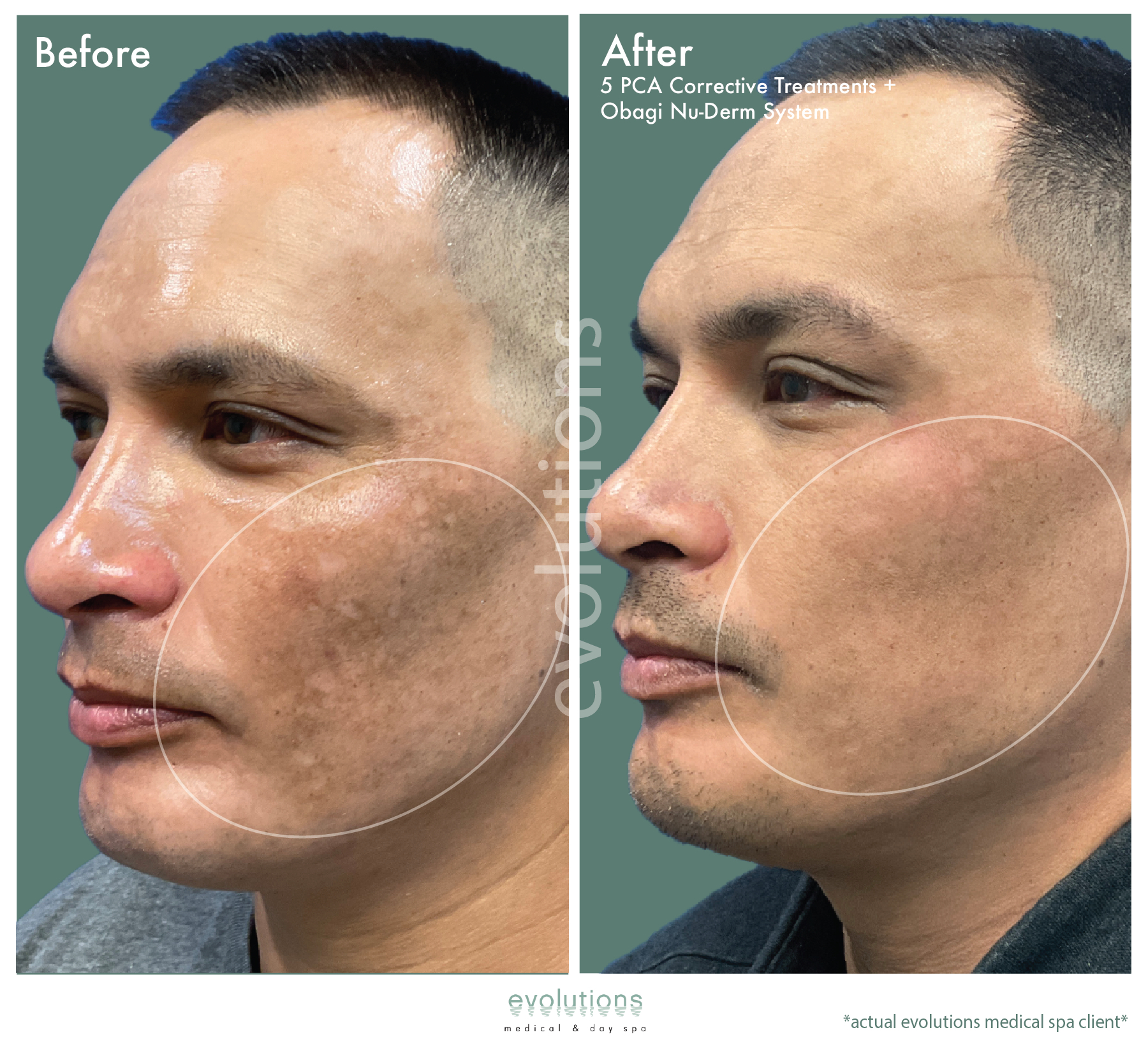 Pca Corrective Obagi Nuderm O Tacbas