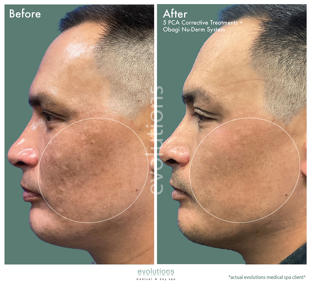 Pca Corrective Obagi Nuderm O Tacbas