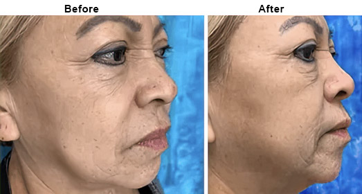 RF Micro Needling: Before And After