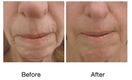 Rf-micro-needling-before-and-after-photos-10-