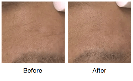 Rf-micro-needling-before-and-after-photos-11-