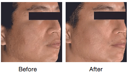 Rf-micro-needling-before-and-after-photos-12-