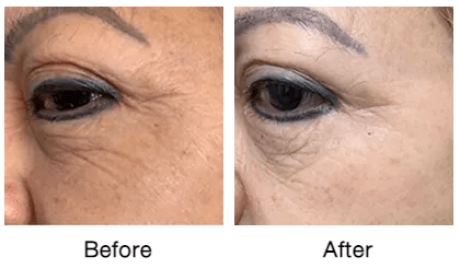 Rf-micro-needling-before-and-after-photos-2-