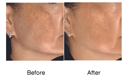 Rf-micro-needling-before-and-after-photos-3-
