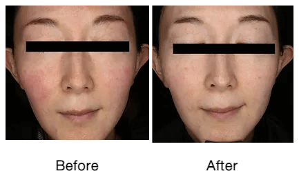 Rf-micro-needling-before-and-after-photos-4-