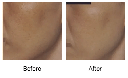 Rf-micro-needling-before-and-after-photos-5-