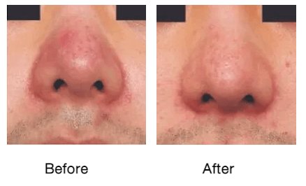 Rf-micro-needling-before-and-after-photos-7-