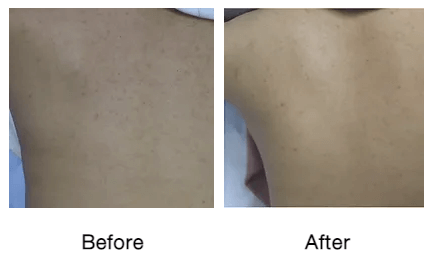 Rf-micro-needling-before-and-after-photos-8-