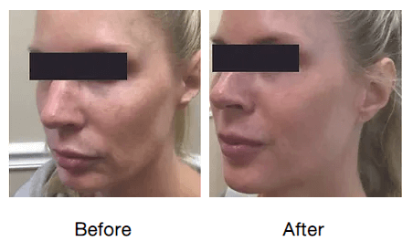Rf-micro-needling-before-and-after-photos-9-