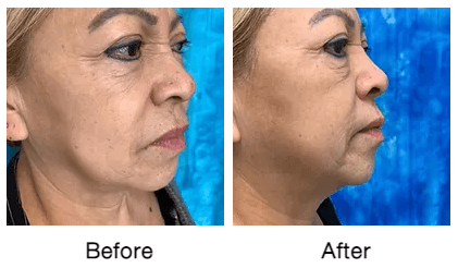 Rf-micro-needling-before-and-after-photos