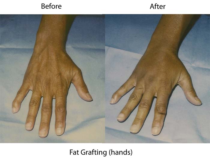 santa barbara hand fat grafting