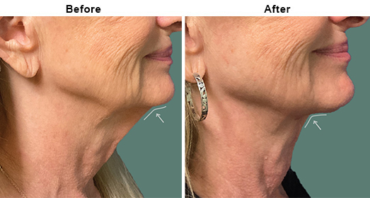 Submentoplasty: Before And After
