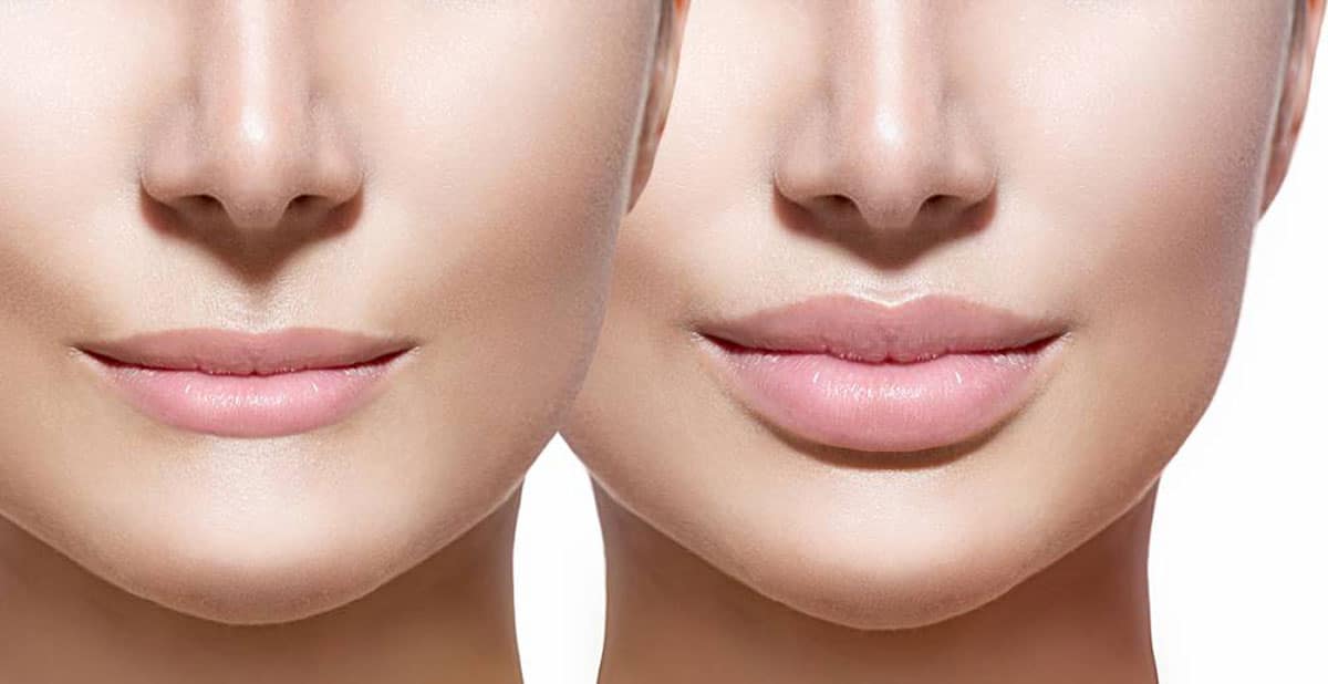 Subnasal Lip Advancement or Lip Lift In Santa Barbara | 805-849-4405 Subnasal Lip Advancement or Lip Lift In Santa Barbara | 805-849-4405