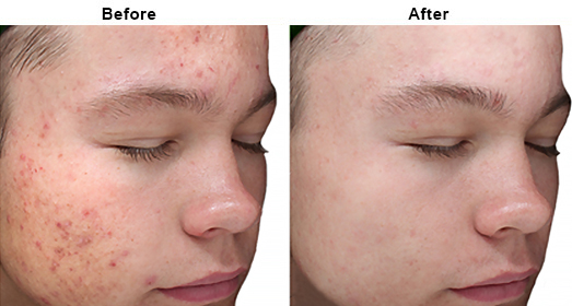 VI Peels: Before And After