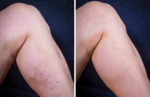 Sclerotherapy in Santa Barbara - Medical Spa Treatment for Unwanted Veins