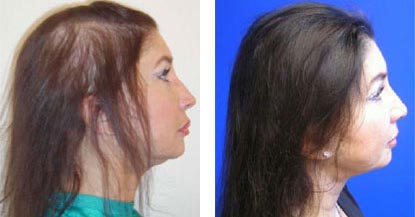 Before And After: Laser Hair Restoration in Santa Barbara