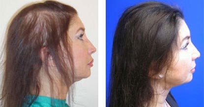 Laser Hair Restoration in Santa Barbara - Female Before and After