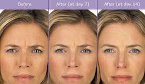 Before And After: Botox Treatment