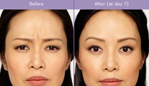 Before And After: Botox Treatment