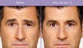 Before And After: Botox Treatment