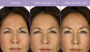 Before And After: Botox Treatment