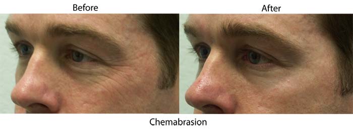 Chemabrasion Enhanced Skin Resurfacing in Santa Barbara for Crow's Feet Wrinkles