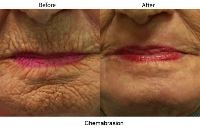 chemabrasion skin rejuvenation santa barbara