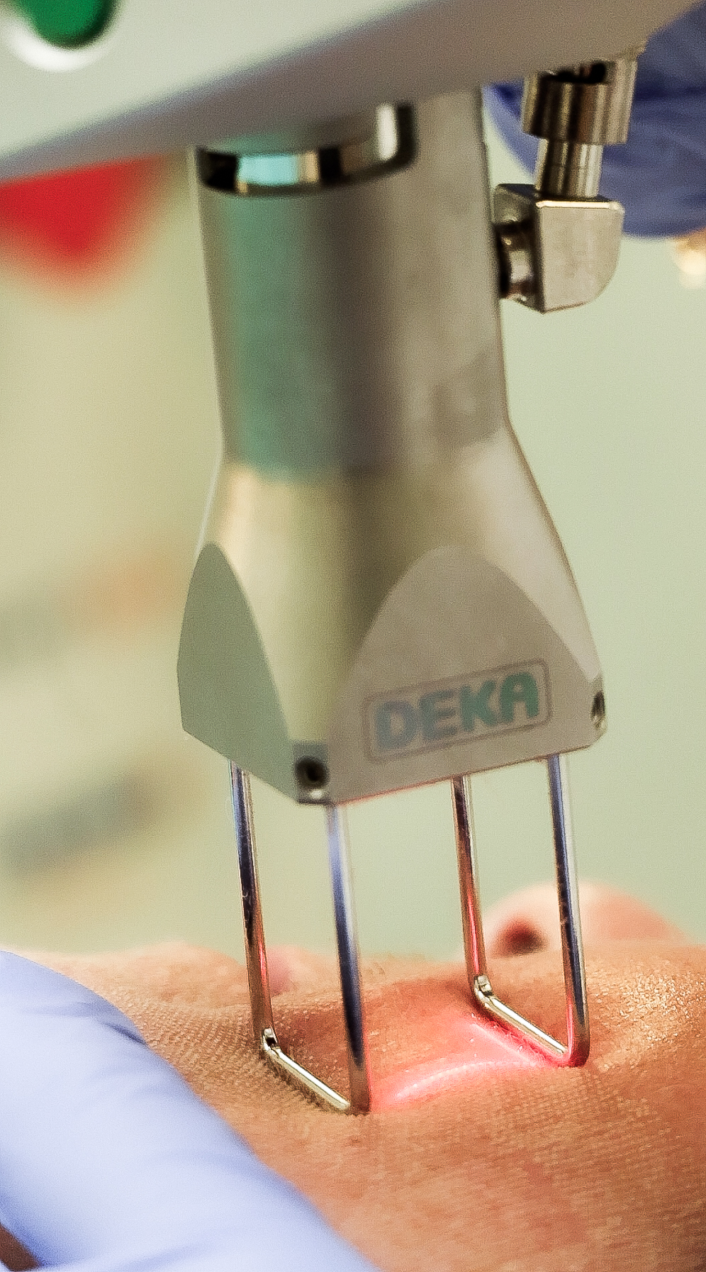 DEKA DOT (Dermal Optical Thermolysis) CO2 Laser treatment