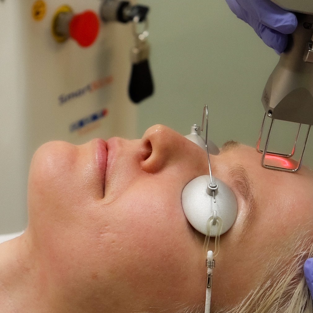 DEKA DOT (Dermal Optical Thermolysis) CO2 Laser treatment