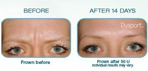 Dysport Treatment in Santa Barbara | Evolutions Medical and Day Spa