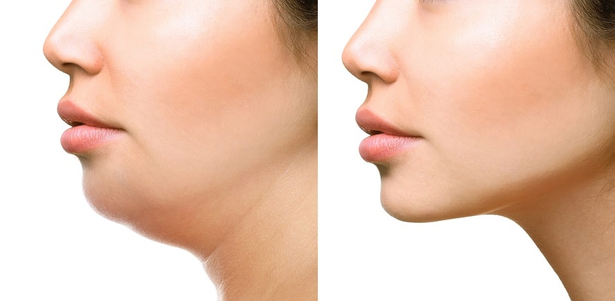Facial liposuction in the lower face and/or the submentum or chin and neck area