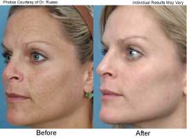 Before And After: Fotofacial Rf